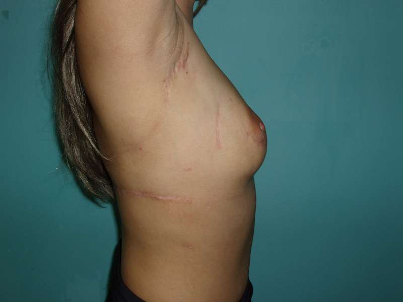 1. Reconstruction with latissimus dorsi flap